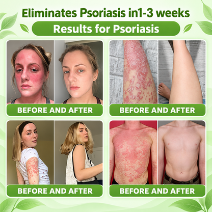 🔥 Only 10 left! Get 30% OFF your second purchase! MOPRO® helps reduce visible scaling, redness, dryness & itching while supporting psoriasis-prone skin. Limited stock — don’t miss out! 💚