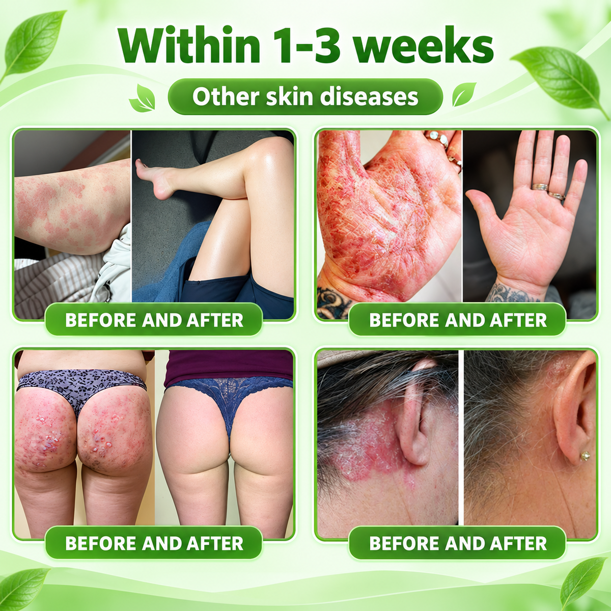 🔥 Only 10 left! Get 30% OFF your second purchase! MOPRO® helps reduce visible scaling, redness, dryness & itching while supporting psoriasis-prone skin. Limited stock — don’t miss out! 💚