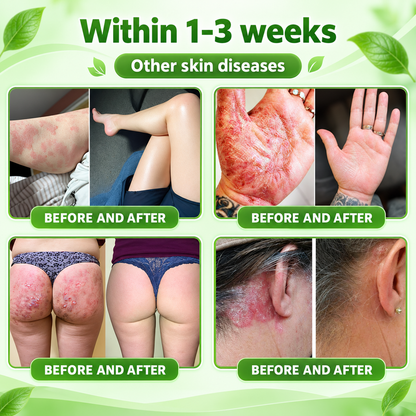 🔥 Only 10 left! Get 30% OFF your second purchase! MOPRO® helps reduce visible scaling, redness, dryness & itching while supporting psoriasis-prone skin. Limited stock — don’t miss out! 💚
