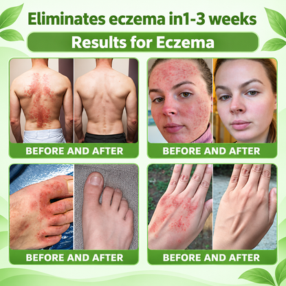 🔥 Only 10 left! Get 30% OFF your second purchase! MOPRO® helps reduce visible scaling, redness, dryness & itching while supporting psoriasis-prone skin. Limited stock — don’t miss out! 💚